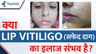 Lips Vitiligo Treatment in India | Case Study \u0026 Recovery Lip Vitiligo Patient | Kayakalp Global