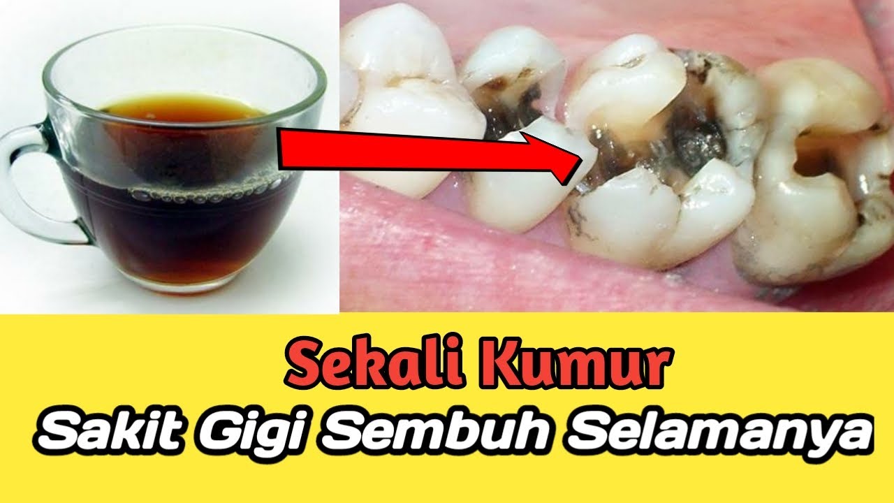 Obat Sakit Gigi Berlubang Paling Ampuh || Cara Mengobati Sakit Gigi ...