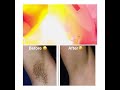 ជំរុះរោមដោយប្រើ laser laser hair remove