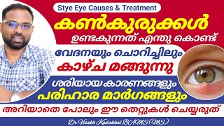 Get rid of Eye stye | കൺകുരു മാറാൻ എളുപ്പവഴി | Eye Stye ; Causes and Treatment | Dr Visakh kadakkal