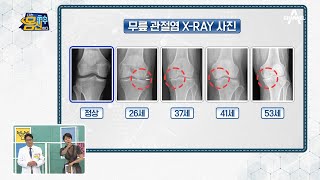 ※나이 불문※ 20대부터 좁아진 관절 간격?! 충격적인 무릎 관절염 X-RAY | 나는 몸신이다 383 회