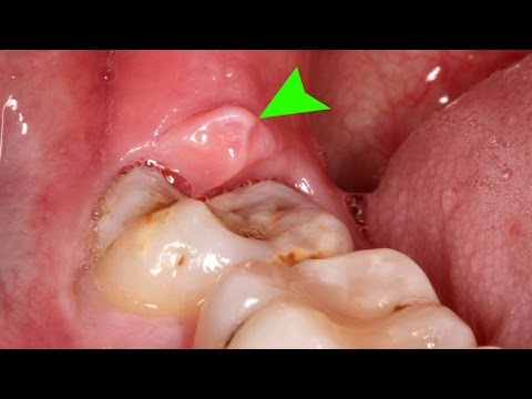 Home remedies for wisdom tooth pain | Wisdom tooth pain in jaw Home remedies for wisdom tooth pain | Wisdom tooth pain in jaw