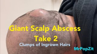 Giant scalp Abscess drained with clumps of long hairs removed and deep sinus tracts explored.