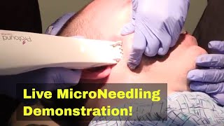 Profound Lift - Jawline and Neck Contouring - Radio Frequency and MicroNeedling Demonstration