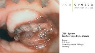 OTSC® System | Boerhaave syndrome closure