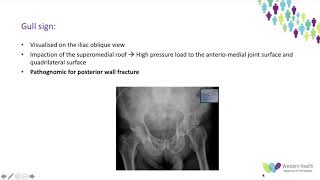 OrthoFracs Acetabular Fractures by Dr. Maya Keeka