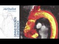 Acute Aortic Syndromes: State of the Art (Kim A. Eagle, MD) March 12, 2020