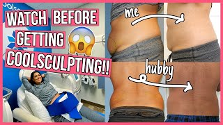 SHOCKING Coolsculpting Before & After: 6 Things You NEED to Know!