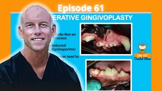 Ep 61 -  Do you recommend electrosurgery for cases of gingival hyperplasia?