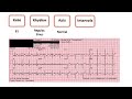 normal sinus rhythm ekg made easy