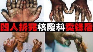 【辐射的烂手】被辐射后肿烂成几倍大，4个小伙自作聪明拆除，毁了多少人！【郑郑得证】