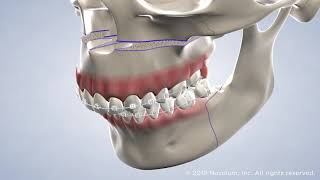 Jaw Surgery at Warren Orthodontics, Springville, UT