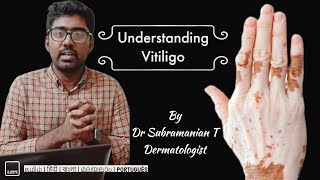 Vitiligo FAQs answered by a dermatologist  @drsubramaniant​