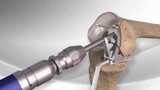 Partial Knee Replacement with the Arthrex® iBalance® UKA