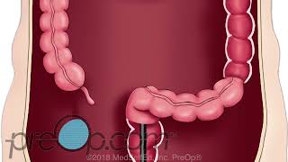 PreOp® Colonoscopy Lower Endoscopy