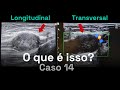 Nodulação No Tornozelo? Como avaliar no ULTRASSOM? | Caso 014 - MSKD