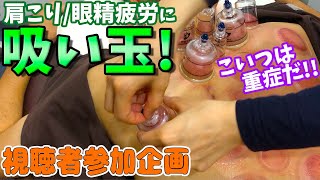 【吸い玉】視聴者さんに吸い玉！ヘルニアと慢性疲労でお悩みの患者さんに吸い玉と鍼を施術しました【カッピング】