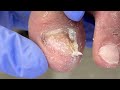 fungus grows wildly on toenails deal with it dr. liu s pedicur