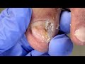 fungus grows wildly on toenails deal with it dr. liu s pedicur