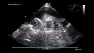 LEFT ATRIAL APPENDAGE CLOSURE PROCEDURE : Role of Transesophageal Echocardiography