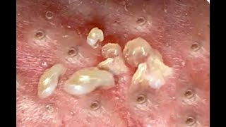 Shocking Cystic Blackheads \u0026 Whiteheads Extraction Revealed / new blackheads this week 001