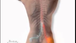 How Spinal Cord Stimulators work