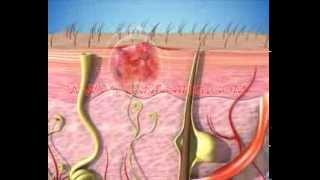 Dermatology Animation