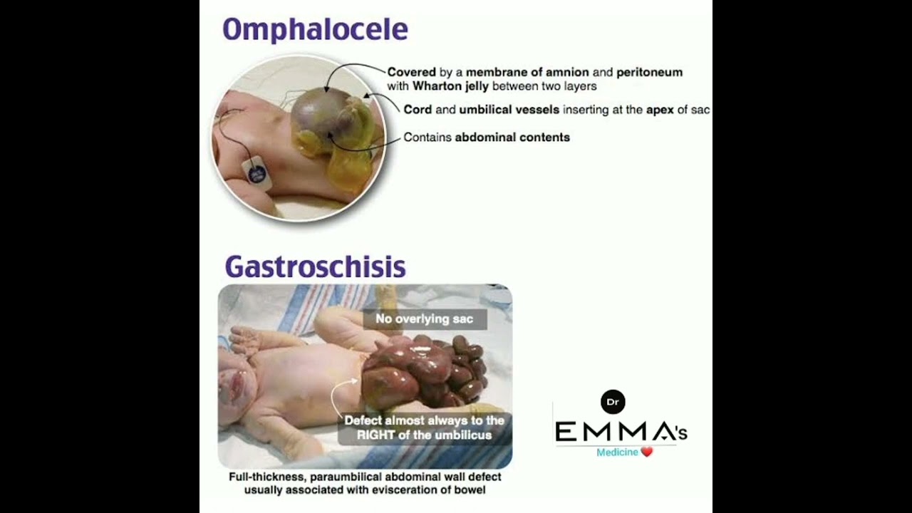 💠 Omphalocele Vs Gastroschisis 💠 - YouTube