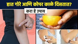 हात गोरे आणि कोपर काळे? | How To Get Rid Of Dark Elbows? | Remedies for Dark Elbows | AI2