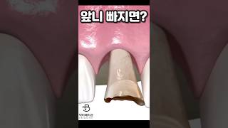 앞니빠지면 어떤일이 발생할까? 앞니임플란트