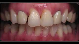 Cosmetic Dentistry Before and After using a Wax up