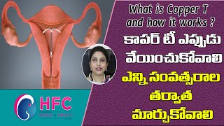 ప్రెగ్నెన్సీ వద్దనుకుంటే ఇదో అత్యుత్తమ మార్గం | Best Way To Avoid Pregnancy | Copper T | #HFC