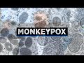 Monkeypox: What you need to know