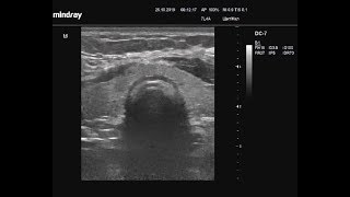 Видеозапись УЗИ - Определение размеров щитовидной железы полная методика свободной рукой