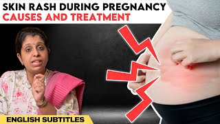 Skin rash during pregnancy | கர்ப்பிணி பெண்களுக்கு உடலில் அரிப்பு ஏற்பட என்ன காரணம் ?