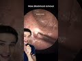 huge blackhead removal. dermreacts pimplepop