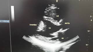 Dr André Chiga: ecocardiograma de trombo no ventriculo