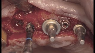 Implant extraction with trephine bur \u0026 implant site preparation with spiral drill of ridge spreader