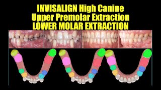 Invisalign Extraction:Upper Premolars, Lower 1st Molar【インビザライン抜歯:上顎小臼歯, 下顎第1大臼歯】