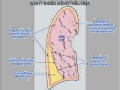 What is Mesothelioma Explained by World Famous Mesothelioma Doctor