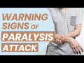 Warning Sign and Symptoms of Paralysis Attack | Signs Before Brain Stroke