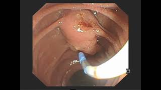 Removal of multiple common bile duct stones