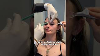 Botox on facial paralysis patient explained #cosmeticinjectables #drazizzadeh