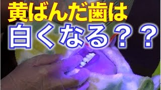 黄ばんでしまった歯はホワイトニングでも白くならない？　口腔ケアチャンネル　586（口腔ケアチャンネル2　＃259）