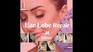 BEST EAR LOBE REPAIR TREATMENT RESULTS | Viral #shorts