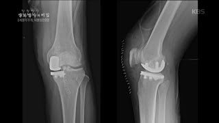 생로병사의 비밀 -모든 관절이 위험하다! 퇴행성관절염의 다양한 부위 및 치료.20160831