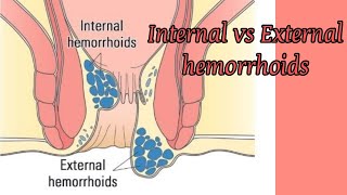 Internal & External Hemorrhoids (Piles) I @DrAshishSachan