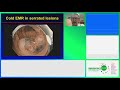 complex colonic emr using the exacto™ cold snare by dr. doug rex