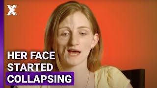 What Causes One Side of the Face to Collapse?