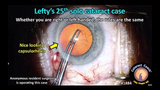 CataractCoach™ 1884: Lefty's 25th solo cataract case